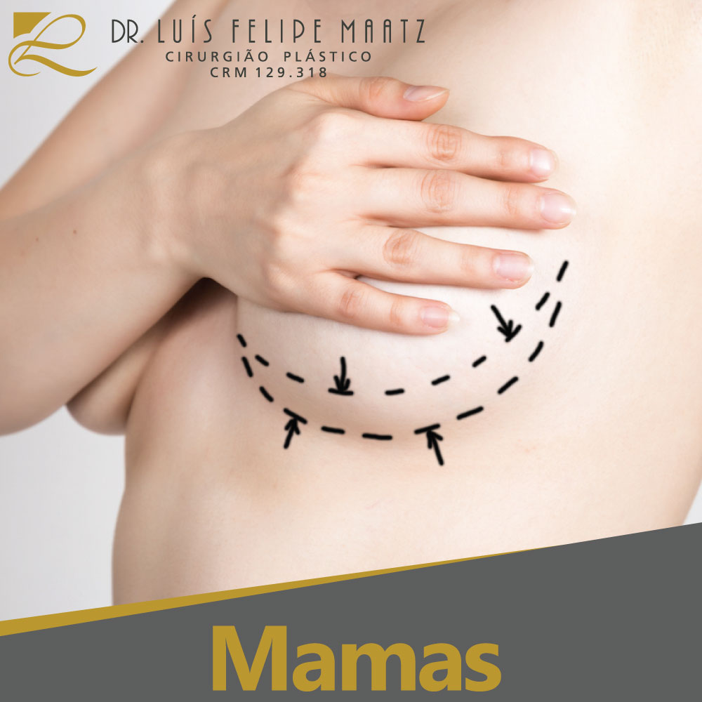 Cirurgia Plástica das Mamas - Clínica de cirurgia plástica Dr. Luís Maatz, localizada na cidade de Jundiaí.